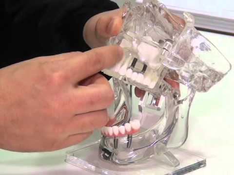 Conheça os vários tipos de implantes odontológicos