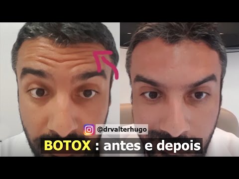 BOTOX Aplicação Botox Antes Depois Dr Valter Hugo