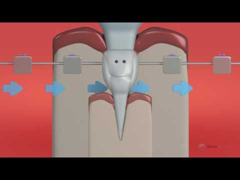 Orthodontic | Aparelho Dental - Como funciona?