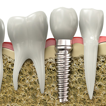 Implante dentário com enxerto ósseo