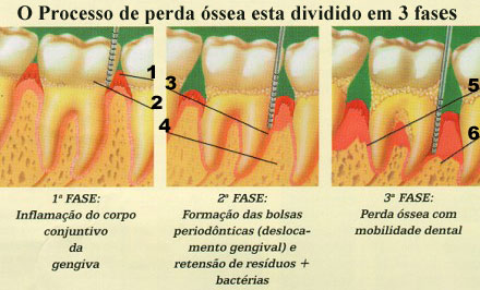 Perda óssea: doença periodontal