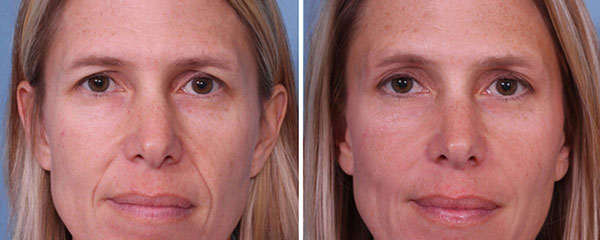 Preenchimento facial com ácido hialurônico