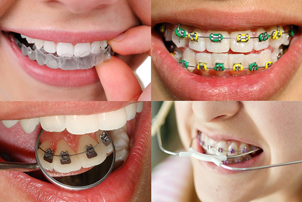 Tipos de aparelho dental